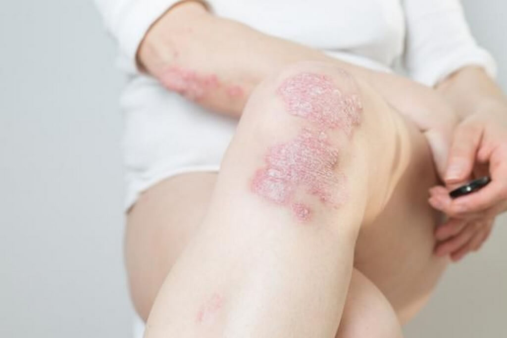 Types of psoriasis: Chronic skin condition