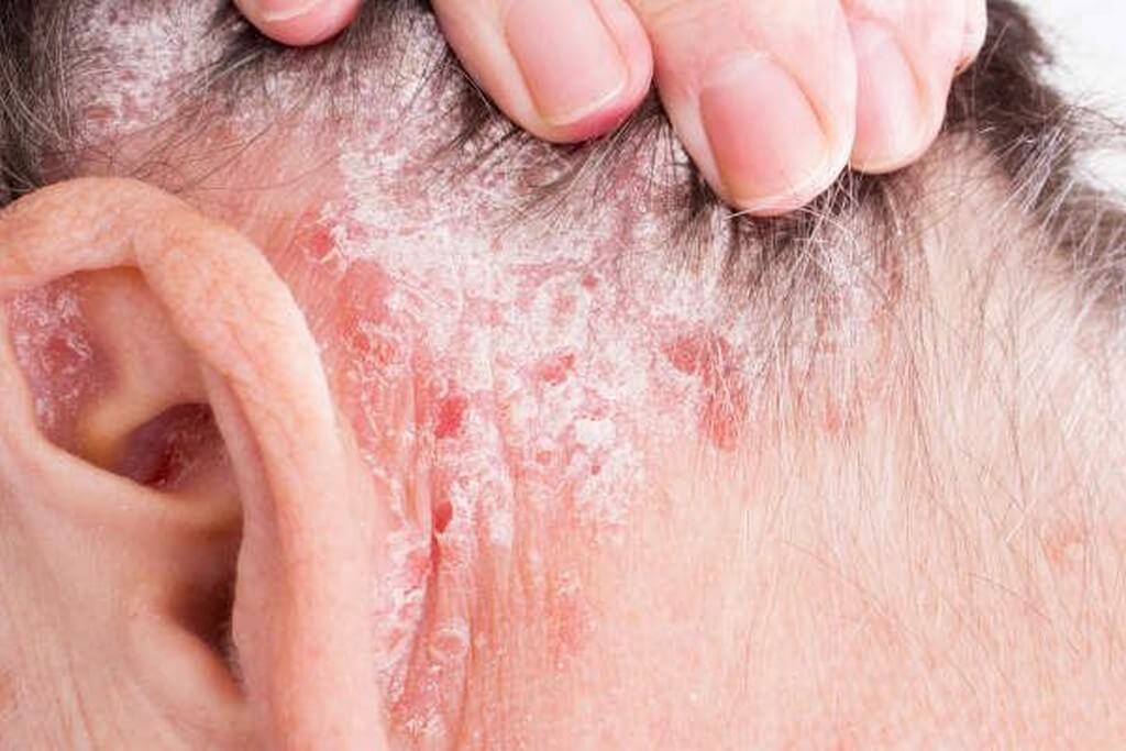 Types of psoriasis: Chronic skin condition