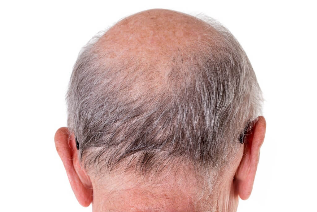 Hair loss: Causes of hair fall in men 