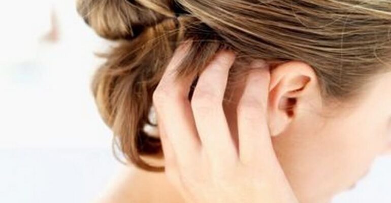 Scalp psoriasis: Effective home remedies for relief