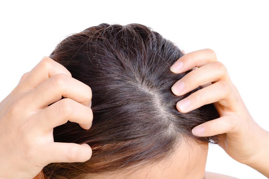 Hair loss: Causes of hair fall in women